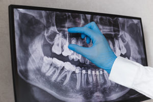 xray of mouth showing dental fillings and sealants sugarland tx