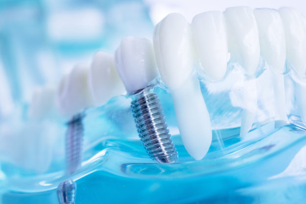 what are dental implants (2) model of teeth and implants showing what are dental implants