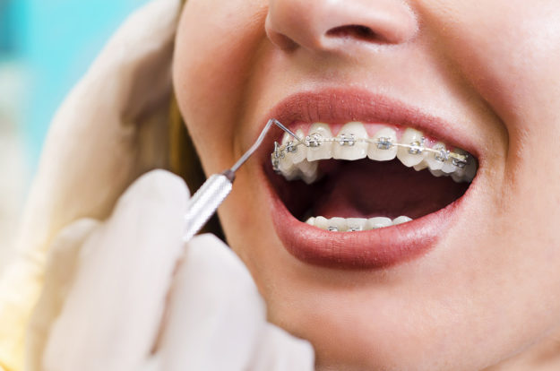 how to prevent teeth shifting woman at dentist with braces learning How to Prevent Teeth Shifting