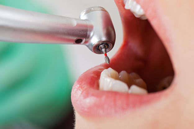 treating a chipped tooth (2) dentist Treating a Chipped Tooth of patient