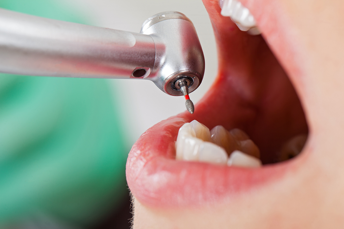 treating a chipped tooth (2) dentist Treating a Chipped Tooth of patient