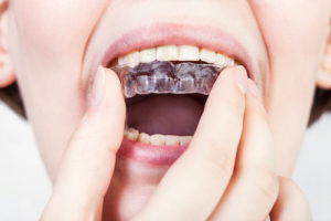 person shows their nightguard which helps with their bruxism