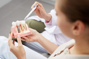 a model of dental implants is shown