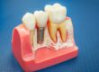 an example of a single tooth implant