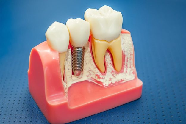 What is a Single Tooth Implant (1) an example of a single tooth implant