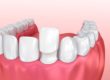 example of what a dental veneer is