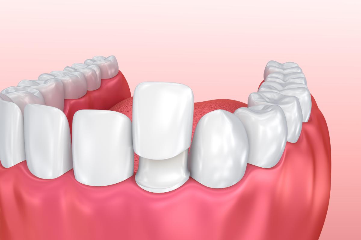 5 Benefits of Dental Veneers example of what a dental veneer is