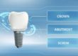 example of a dental implant