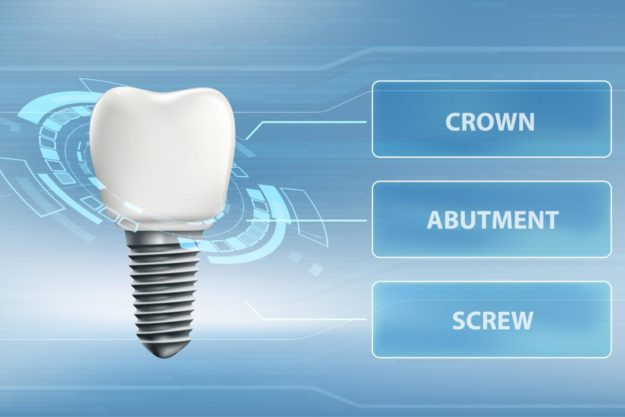 How Do Dental Implants Work example of a dental implant